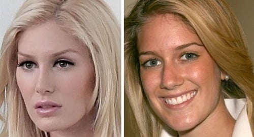 Heidi Montag plastic surgery